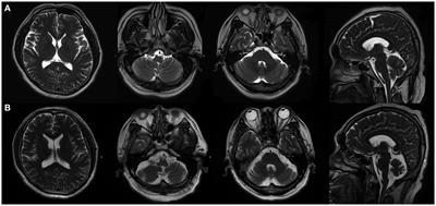 Cerebellar encephalitis associated with anti-mGluR1 antibodies: a case report and comprehensive literature review